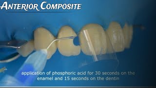 Class III Composite restoration Full case protocol from A to Z [upl. by Aimas]