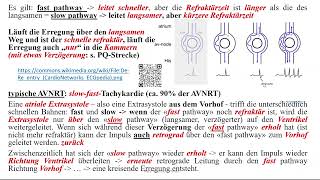 Herzrhythmusstörungen  Paroxysmale supraventrikuläre Tachykardien 1 AVNRT [upl. by Cartwright]