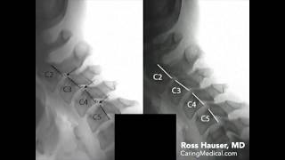 Improvement of cervical anterolisthesis DMX review with Ross Hauser MD [upl. by Navonod]