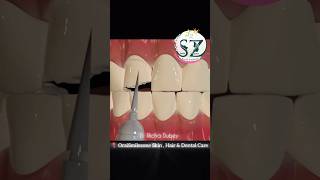 Restore your broken toothoraismilezone drrichadubey tooth dentalcare shortsfeed shorts [upl. by Nailij932]