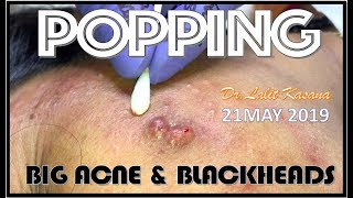 BIG PIMPLE and BLACKHEAD POPPING by DRLALIT KASANA 21MAY 2019 [upl. by Vershen871]