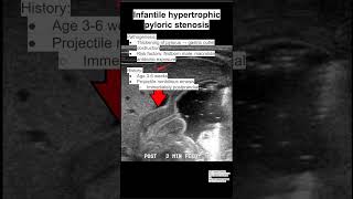 Infantile hypertrophic pyloric stenosis [upl. by Vergos]