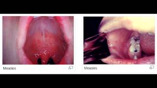 Koplik spots measles rubeola virus [upl. by Ranite]