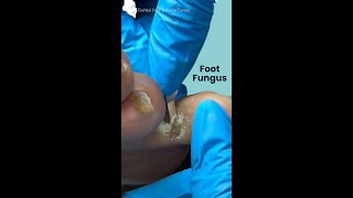 Cleaning up an Athletes Foot footfungus footfungal footdoctor [upl. by Halueb]