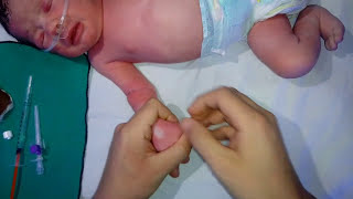 تركيب كانيولا للاطفال IV cannula insertion for baby [upl. by Boice761]