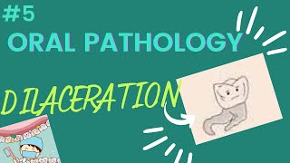 DILACERATION in dentistry [upl. by Quintie246]