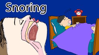 Snoring  Causes and Treatment How to stop snoring [upl. by Sims670]