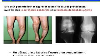 traumatologie Gonarthrose [upl. by Kcirdle]