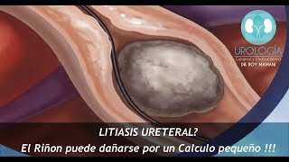 LITIASIS URETERAL  Dr Roy Mamani [upl. by Lilithe]