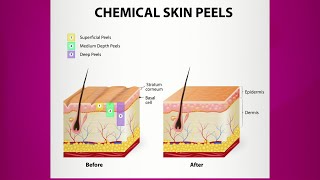 Chemical Peel Purpose amp Types [upl. by Nonnair259]