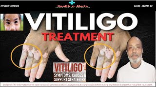 Vitiligo  Tips and Support Strategy [upl. by Nesbitt]