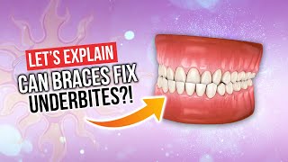 Can Braces Fix UNDERBITES [upl. by Nickerson]