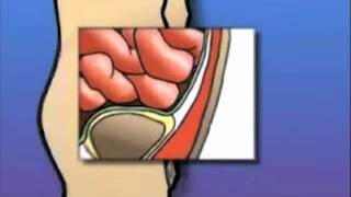 GASTROCIRURGIA  Vídeos  Hérnia Inguinal [upl. by Prudie]