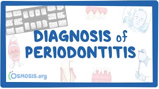 Diagnosis of Periodontitis [upl. by Farika820]