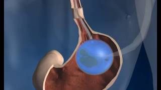 Gastric Balloon Surgery  how it works  Phoenix Health [upl. by Leryt]