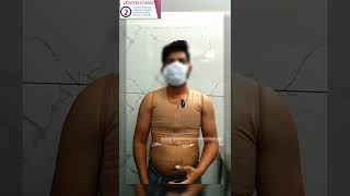 Gynecomastia in Ahmedabad  Gynecomastia Surgery Cost in Ahmedabad  Zenith Clinic [upl. by Ahsener]