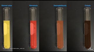 Hematuria Hemoglobinuria Hemosiderinuria and Coluria [upl. by Icats511]