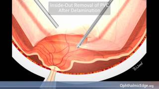 Diabetic Tractional Retinal Detachment [upl. by Reena953]