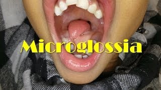 A Rare Case of Microglossia [upl. by Thalia]