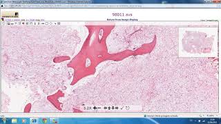 Odontogenic Myxoma Mixoma Odontogénico🔬odontogenictumors Myxoma [upl. by Hnim]