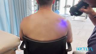 Upper Back and Neck Subzero cryotherapy treatment instruction video [upl. by Drona54]