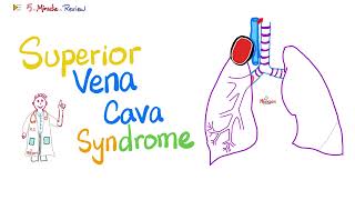 Superior Vena Cava SVC Syndrome  Pancoast Tumor  Pathology  Oncology  5MinuteReview [upl. by Ardle]