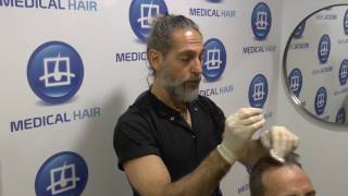 ¿Cómo se aplica el minoxidil Detener la caída del pelo [upl. by Mcclenaghan]