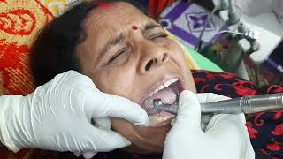 Apex locator Diye kivabe root canal kurte hoi chambar Auro dental care 01739117120 [upl. by Siana]