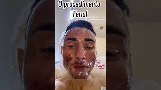 7 Meses depois do procedimento de Fenol Profundo para tratar cicatrizes de acne [upl. by Webber]