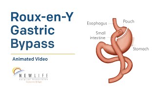 RouxenY Gastric Bypass [upl. by Annawit]