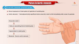 PULSES IN AORTIC STENOSIS  Usmle Cardiology [upl. by Nalrah]