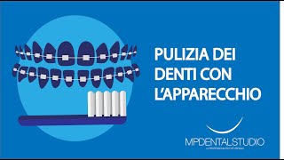 Come pulire i denti con lapparecchio fisso [upl. by Leigh]