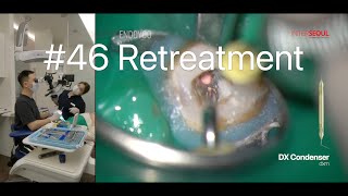 46  Retreatment of Mandibular Molar with Microscope 33 [upl. by Berkow]