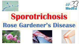 Sporotrichosis Rose Gardener’s Disease Causes Risks Types Symptoms Diagnosis Treatment [upl. by Melosa]