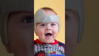 Infant Helmet Therapy Brachycephaly Flat Head Treatment UK [upl. by Eniawtna428]