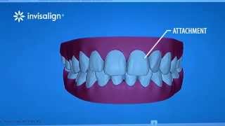 What You Can Expect During Invisalign Treatment [upl. by Jabe226]