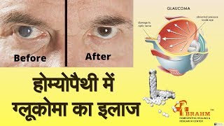 glaucoma ka ilaj होम्योपैथी में ग्लूकोमा का इलाज  Glaucoma treatment in homeopathy  Dr pradeep [upl. by Annaet971]