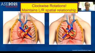 Echocardiography approach in patients with dextrocardia [upl. by Yelruc]