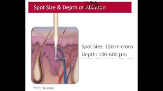 New SandstoneEllman Matrix LS40 Fractional CO2 Laser with 1 Year Warranty [upl. by Olen]