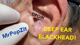 DPOW with firm blackhead lodged deep in ear Keratin pocket expressed just behind ear pearlMust see [upl. by Aiynat419]