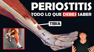 PERIOSTITIS TIBIAL Su TRATAMIENTO y lo que debes saber [upl. by Dadivitan]