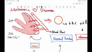 Ischemic heart disease ACS part 1 [upl. by Aicatsan757]