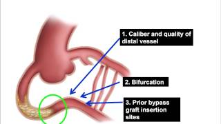 CTO PCI performing and analyzing the angiogram [upl. by Fidela]