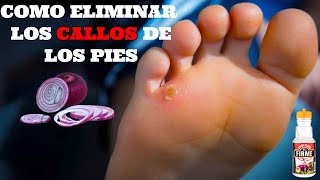 Como Quitar los CALLOS Delos DEDOS Delos PIES RAPIDAMENTE ❅ Como QUITAR CALLOS en Dedos de PIES [upl. by Rossuck]