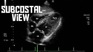 Echo subcostal view [upl. by Gnep658]