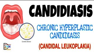 CANDIDIASIS  PRIMARY CHRONIC FORM  HYPERPLASTIC CANDIDIASIS OR CANDIDAL LEUKOPLAKIA [upl. by Ott]