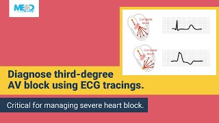 Examining a thirddegree AV block [upl. by Meakem]