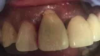 Immediate Implant 8 severe bone loss no buccal wall [upl. by Marven]