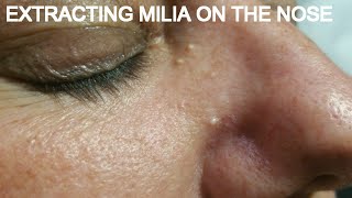 EXTRACTING MILIA ON THE NOSE [upl. by Jonati]