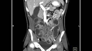 Abdomen Small Bowel EnteritisSeries of coronal sagittal volume rendered and MIP images1 of 6 [upl. by Biagi758]